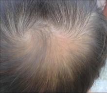 脂溢性脱发对患者的危害大吗